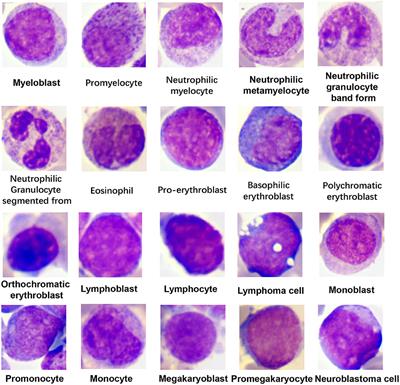 Development and Evaluation of a Leukemia Diagnosis System Using Deep Learning in Real Clinical Scenarios